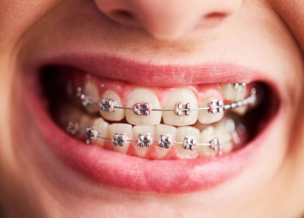 When braces get wrong?