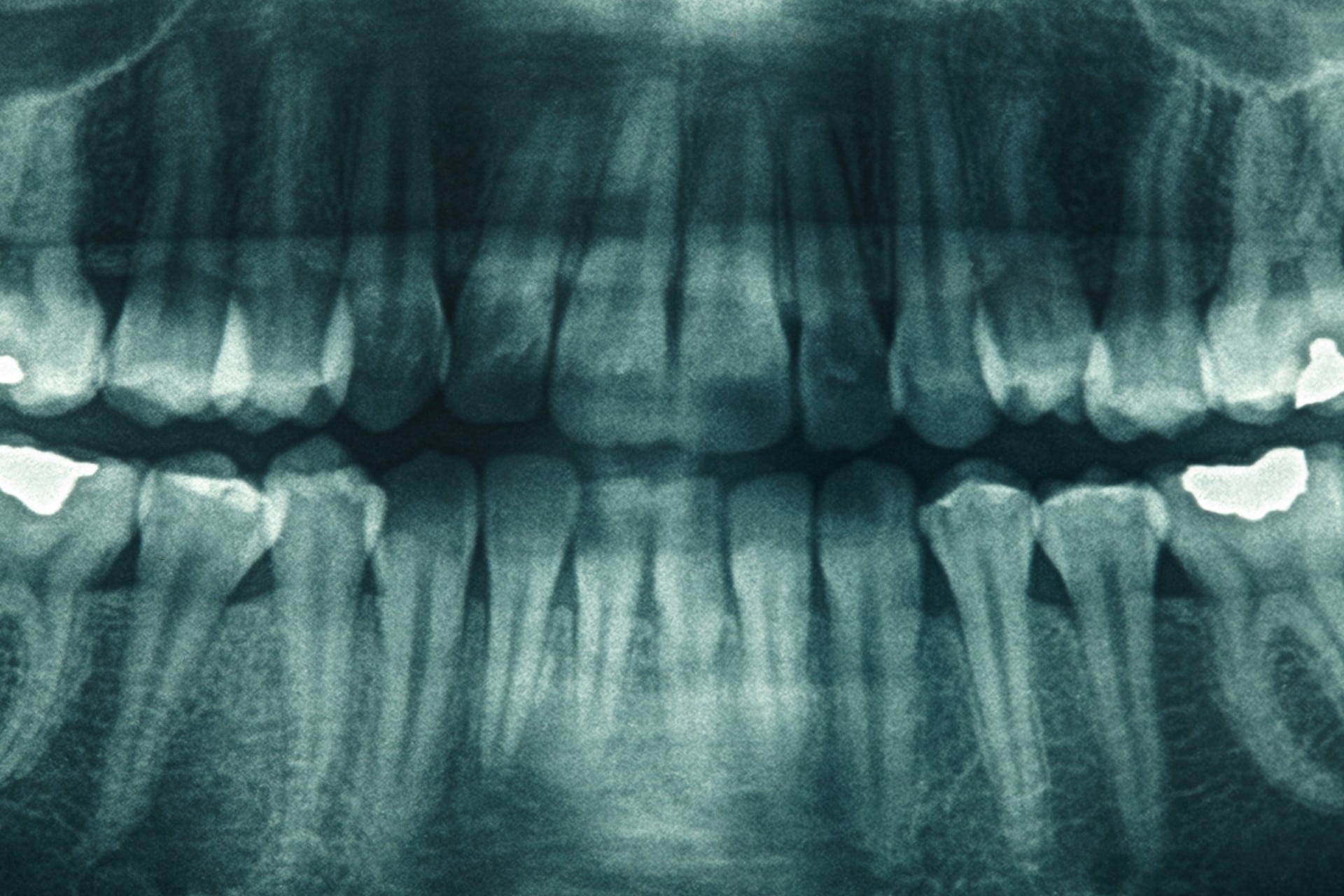 Everything about dental Xrays Somos Dental